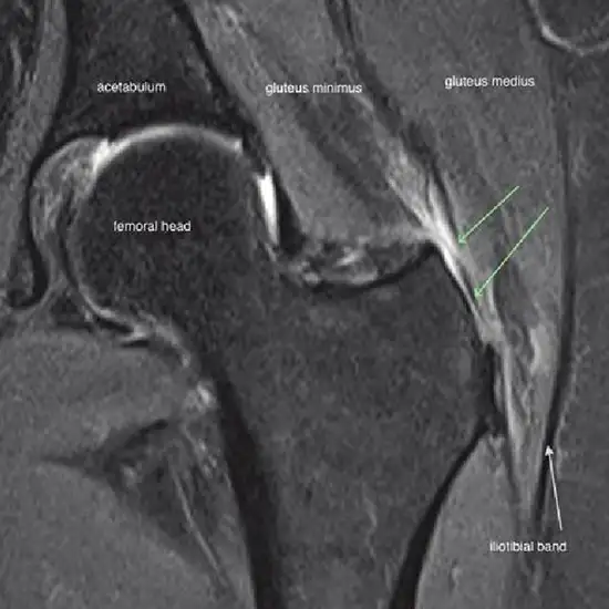 MRI Gluteal and Spine Test